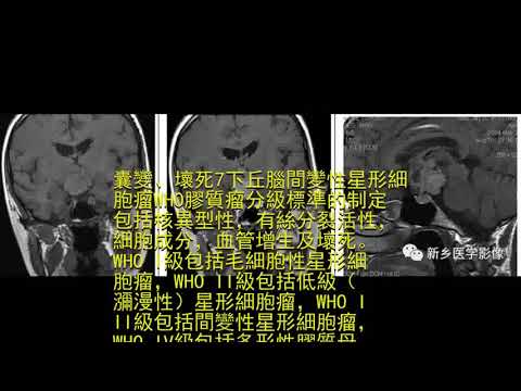 鞍上14種強化腫塊匯總