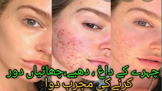 acne, freckles, pigmentation, Health, beauty, tips, treatment, Desi, skin, face, facial, burn, pors