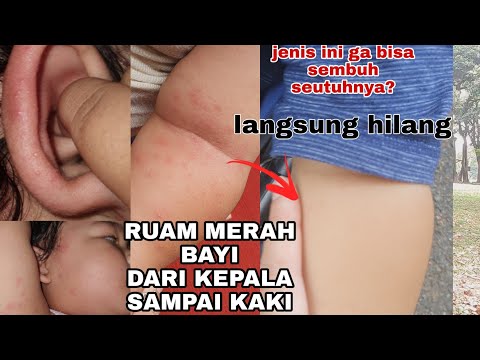 Pengalaman Cara Mengatasi Ruam Merah pada bayi Langsung sembuh dalam sehari