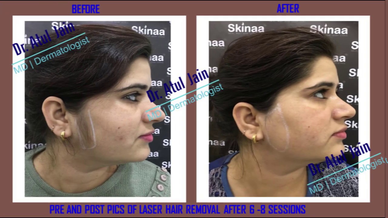 Laser Hair Removal At Dr. Atul Jain's Skin, Hair and Laser Clinic , Jaipur  - YouTube