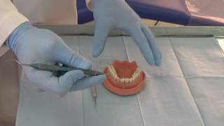 Eliminación cálculo dental mediante el uso de curetas