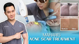 CARA MENGHILANGKAN ACNE SCARS ATAU BEKAS JERAWAT PALING EFEKTIF!