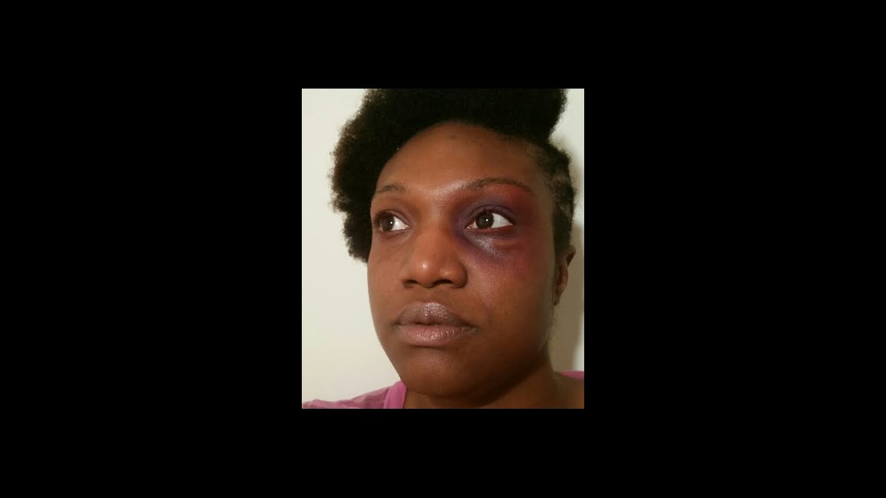 Halloween/SFX Black Eye! *Viewer Discretion is Advised* YouTube