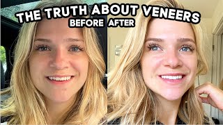 What They Don't Tell You About Getting Veneers: Pain, Cost, Is It Worth it?