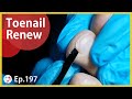 Ep.198 - Renew Lady&#39;s Toenails