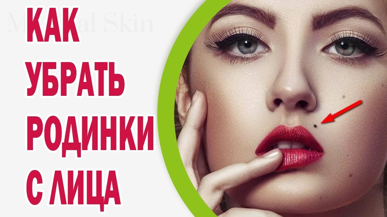 Удалить бородавку в екатеринбурге
