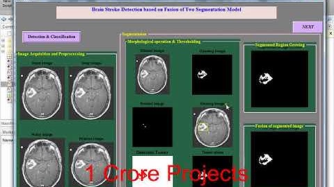 Brain Stroke Detection Based On Fusion Of Two Segmentation Model-1Crore Projects