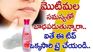 ముఖం పై మొటిమలు తగ్గాలంటే ఇలా చేయండి  I Pimples Problem Solution in Telugu I Everything in Telugu