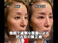 他院で脱脂されすぎた方の修正術　前後　オキュロフェイシャルクリニック鹿嶋友敬　#ハムラ #脱脂 #修正　リスク;出血・感染・過矯正・低矯正