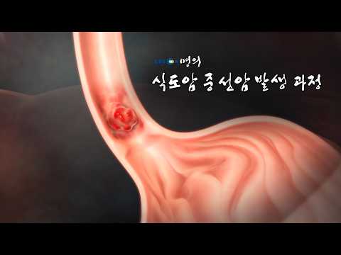 [Master’s Medical Encyclopedia📖] The Development Process of Esophageal Adenocarcinoma