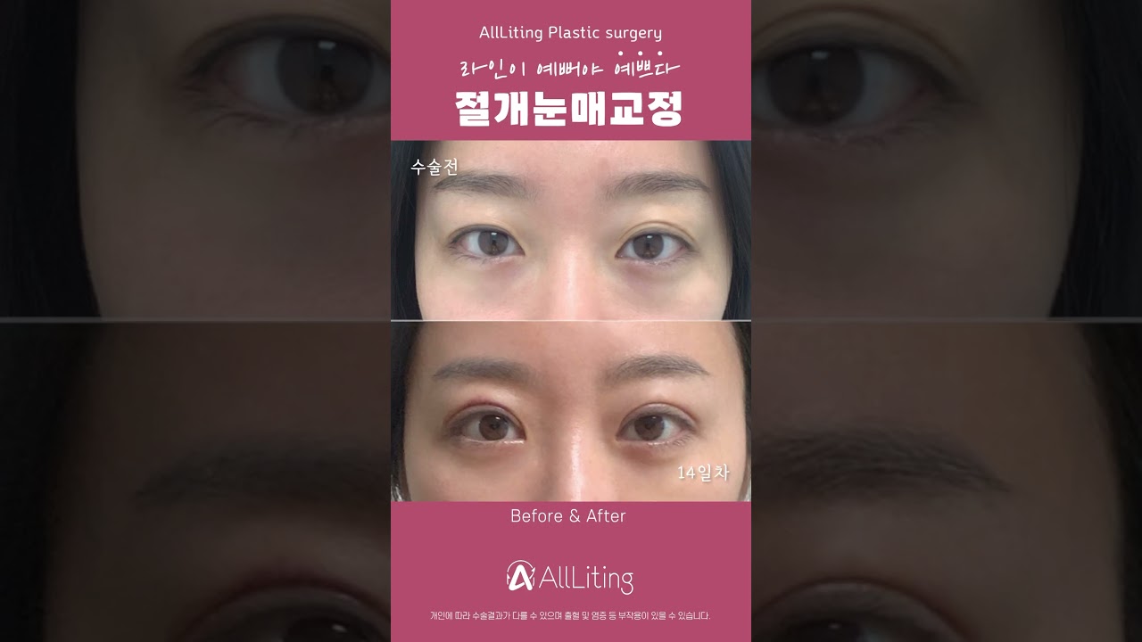 [奧麗婷整形外科診所] #透過切開式提眼瞼肌手術 #大小眼矯正 和 多層眼摺 一次✊搞定😈 #切開式提眼瞼肌手術腫脹 #切開式提眼瞼肌手術費用 #切開式提眼瞼肌手術知名診所 #江南 #整形外科