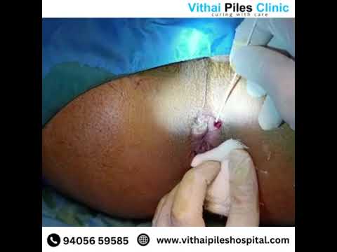 Step 1- Laser Hemorrhoidoplasty Laser Surgery for Piles at Vithai Piles Hospital PCMC