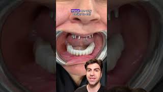 All-On-4 Dentures A Revolutionary Solution For Missing Teeth