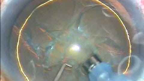 Hydrodelineation , Direct chop and use of Bimanual Irrigation & Aspiration