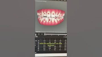 Poway Dentist Explains Invisalign IPR vs Extractions #shorts