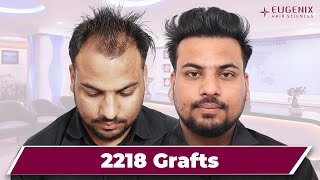 Hair Transplant in Chennai | Best Results & Cost of Hair Transplant in Chennai