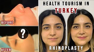 Rhinoplasty in Turkey - FULL EXPERIENCE | Affordable and Good Quality (HEALTH TOURISM IN TURKEY)