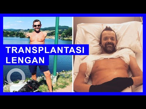 Pria yang Jalani Transplantasi Lengan Pertama di Dunia Kini Pulih dengan Baik - TomoNews