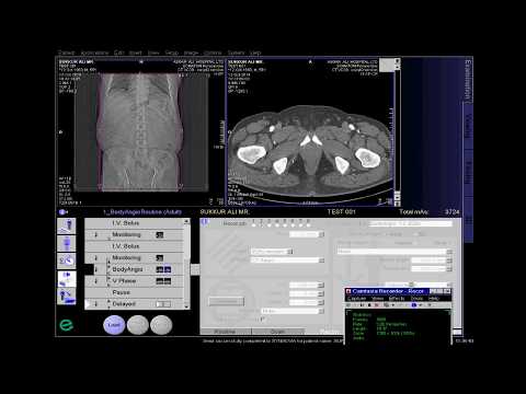 CT Abdominal angio Full Work Process (SIEMENS) in syngo acquisition workplace