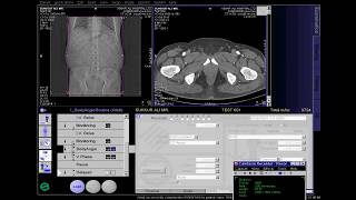 CT Abdominal angio Full Work Process (SIEMENS) in syngo acquisition workplace