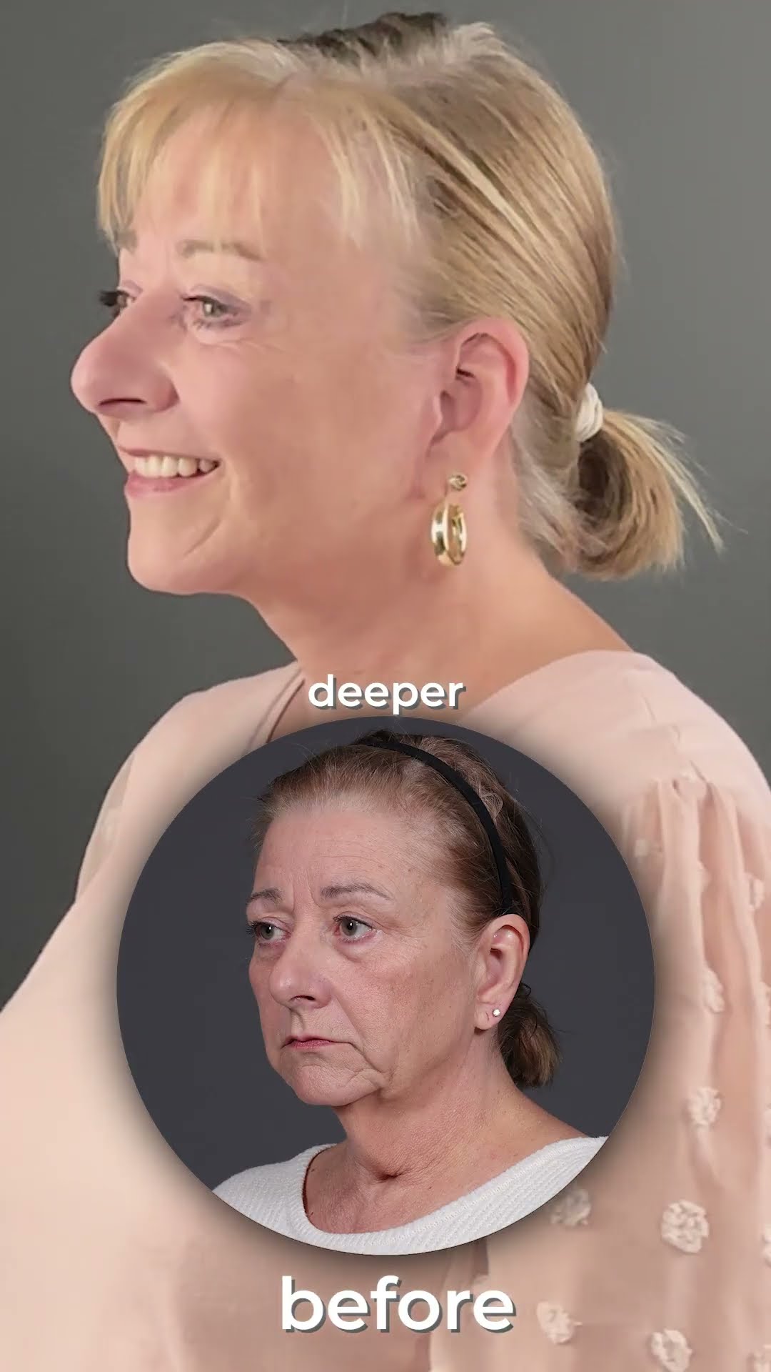 Facelifts in your 40s vs your 60s
