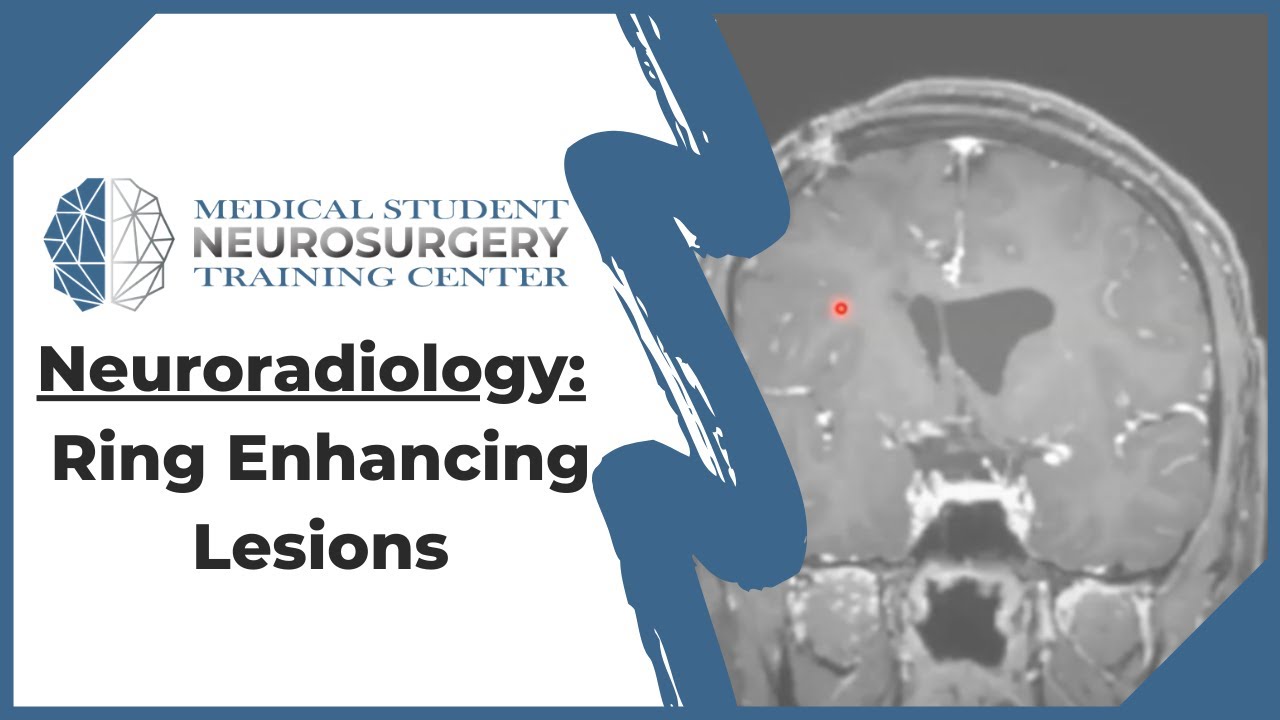 Cerebritis/Abscess | The Neurosurgical Atlas