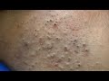 ASMR Deep Pore Cleansing and Blackheads Removal | Ultimate Skin Care Routine
