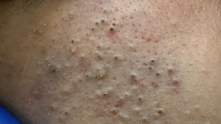 ASMR Deep Pore Cleansing and Blackheads Removal | Ultimate Skin Care Routine