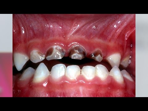 वीडियो: बच्चे में दांतों की सड़न से कैसे बचें