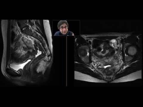 Uterine agenesis (Mayer-Rokitansky-Küster-Hauser syndrome) — video thumbnail