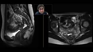 Uterine agenesis (Mayer-Rokitansky-Küster-Hauser syndrome)