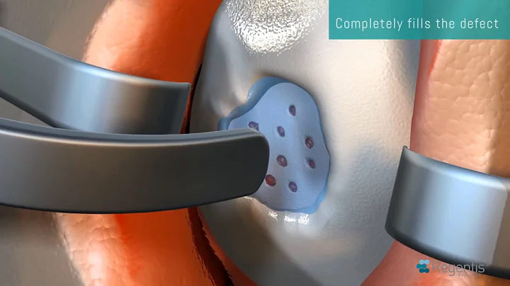 GelrinC Implant | Narrated MOA Animation | Articular Cartilage Repair | Regentis Biomaterials