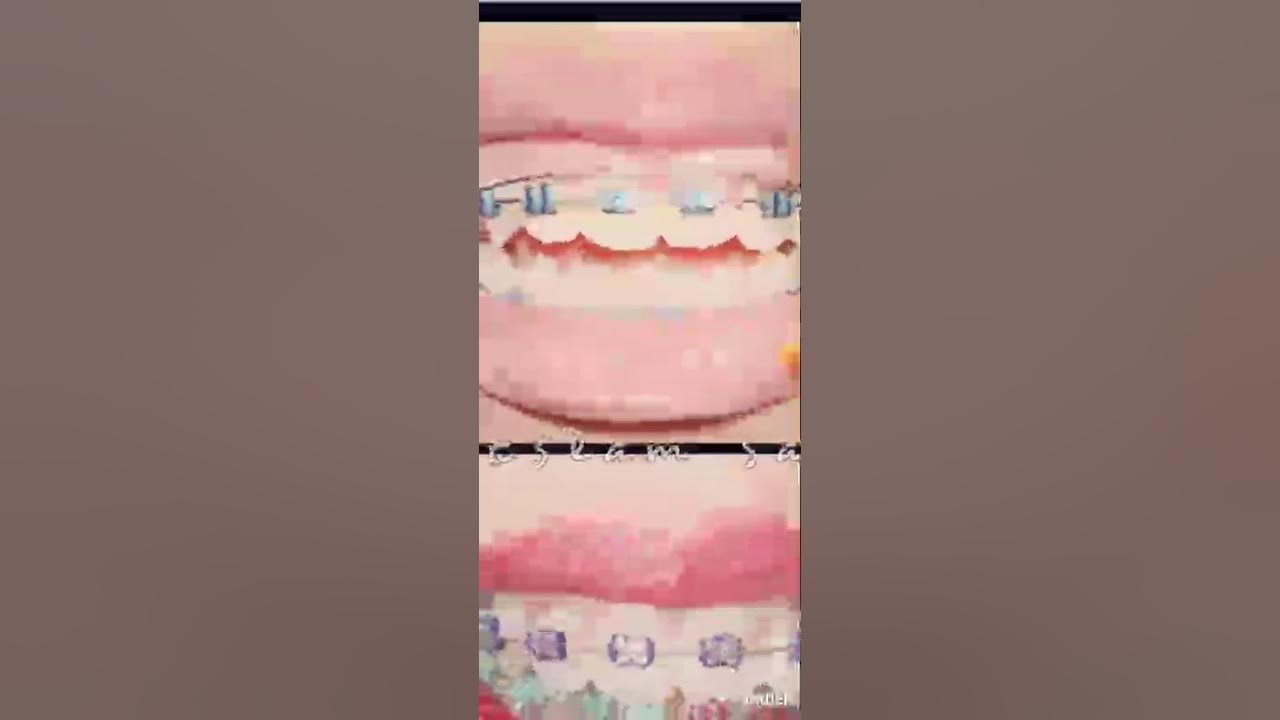 orthodontic trick 2 YouTube
