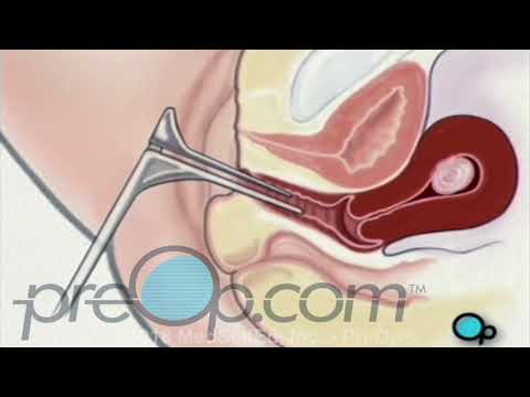 Vaginal Fibroid Removal Myomectomy Surgery • PreOp Patient Education