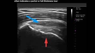 MSK Ultrasound: The Dynamic resisted rotator cuff stress test