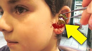 Surgeon Struggles To Remove A Living Snake From A Young Boy’s Ear, Then This Happens