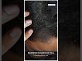Dandruff Causes Hair Fall Shorts Viral Dandruff