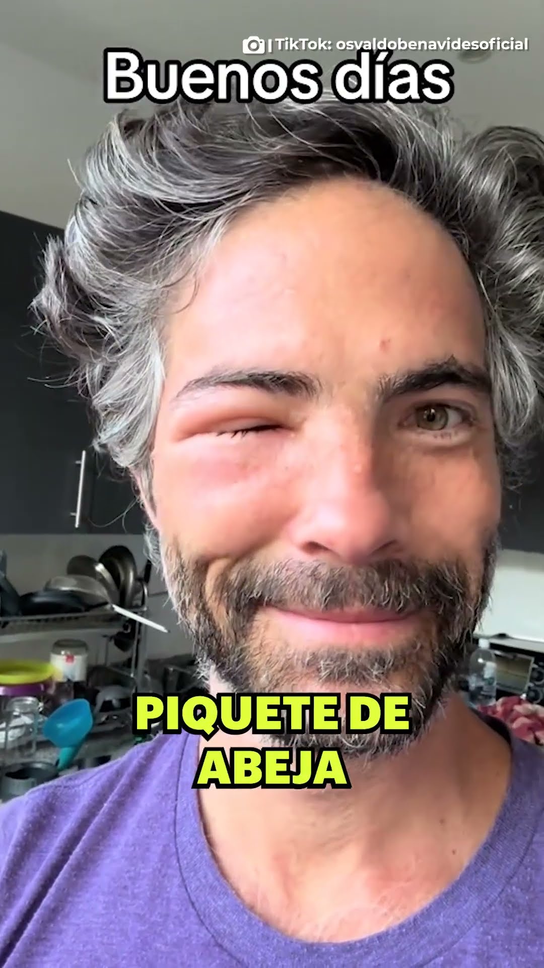 Osvaldo Benavides impacta al mostrar rostro DESFIGURADO ? #News