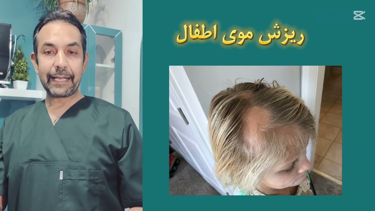 علت ریزش موی اطفال و درمان آن