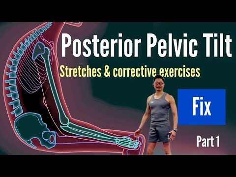 Posterior pelvic tilt