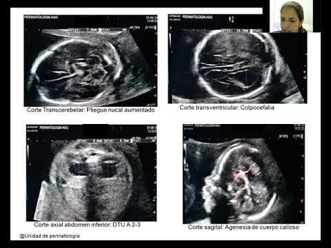 Video: ¿Qué es el síndrome de trisomía 8?