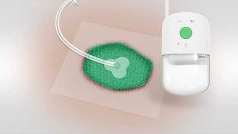 Learn how to setup and use the Avance Solo Adapt NPWT system