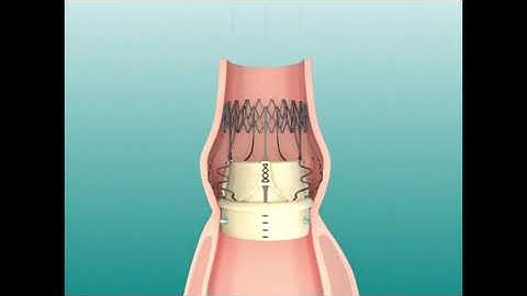 Aortic sutureless valve deployment 3D animation