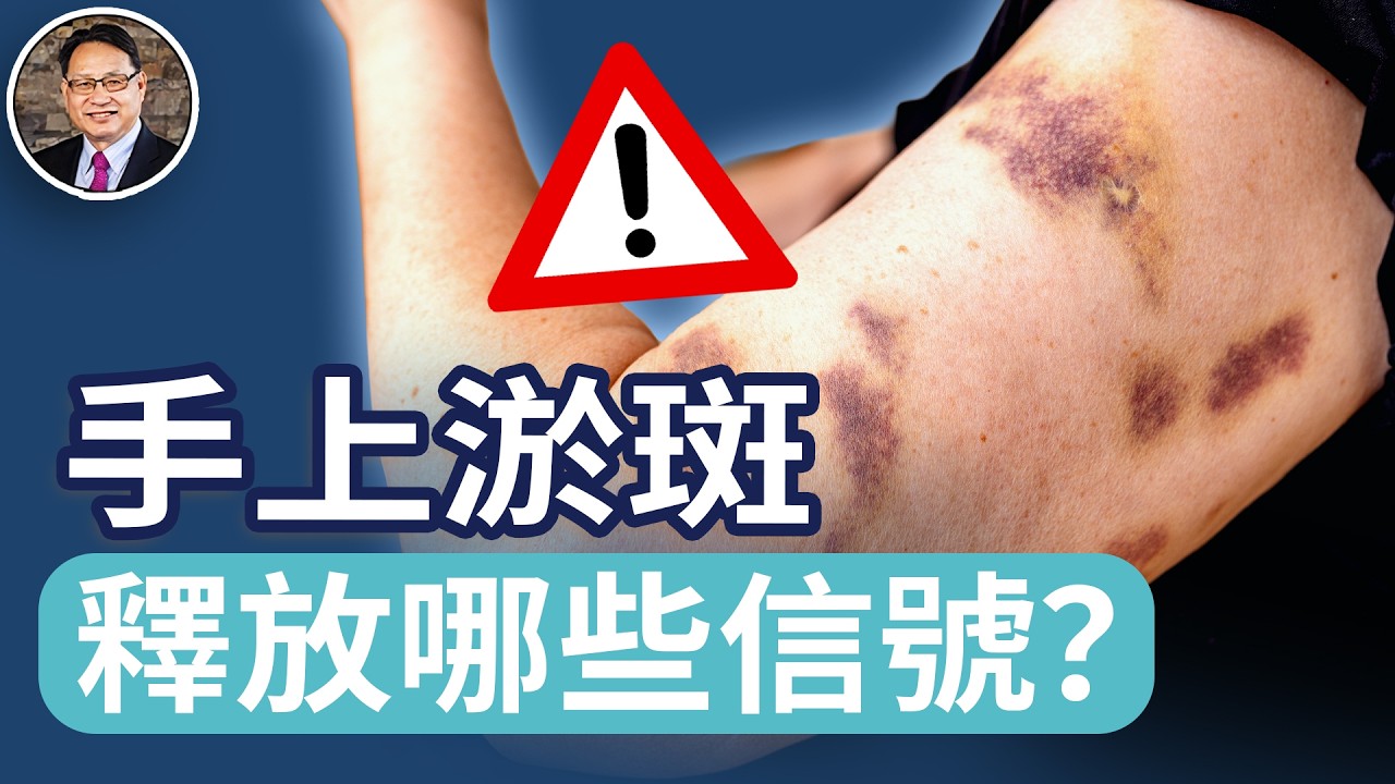 川普手上驚現淤斑，可能隱藏的健康風險？老年人如何進行健康管理？怎樣判別「良性瘀斑」與「健康警訊」？
