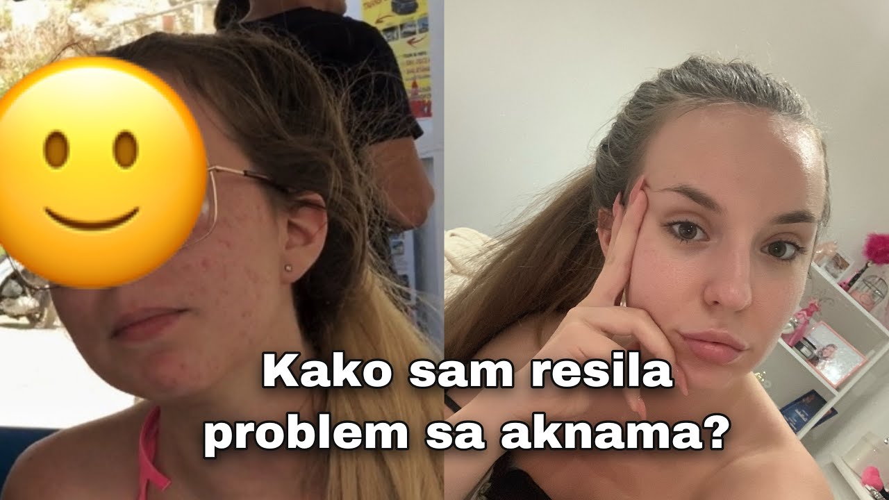 Kako sam resila problem sa aknama? STORY TIME