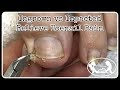 👣Ingrown Toenail and Impacted Toenail Relief and Prevention PedicureTutorial 👣