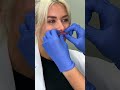 What Happens when Lip Filler Gets Dissolved?