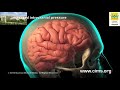 Craniotomy and Craniectomy (Hindi) - CIMS Hospital