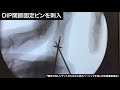 動画6-1　骨性槌指　石黒変法
