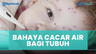 Bahaya Cacar Air Bisa Menyerang Tulang dan Paru-Paru